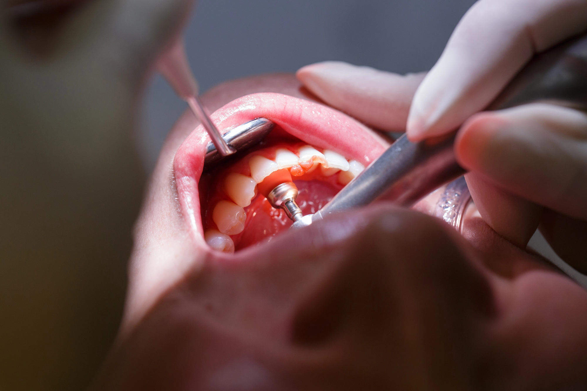 Veja dentalne medicine je paradontologija, ki se ukvarja z zdravljenjem dlesni in obzobnih tkiv